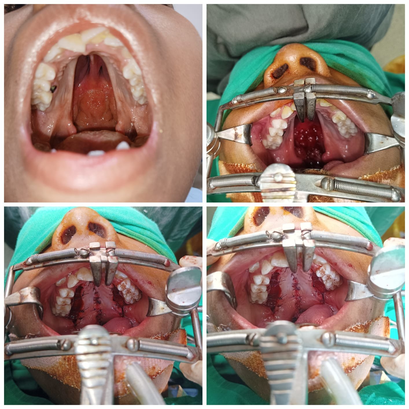 cleft palate